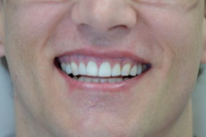patient-01-after | Taylor Dental Implants and Aesthetics