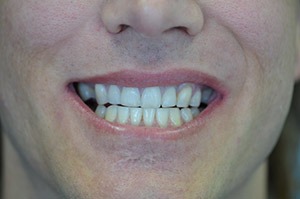 patient-01-before | Taylor Dental Implants and Aesthetics