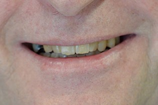 patient-02-after-b | Taylor Dental Implants and Aesthetics