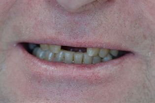 patient-02-before-b | Taylor Dental Implants and Aesthetics