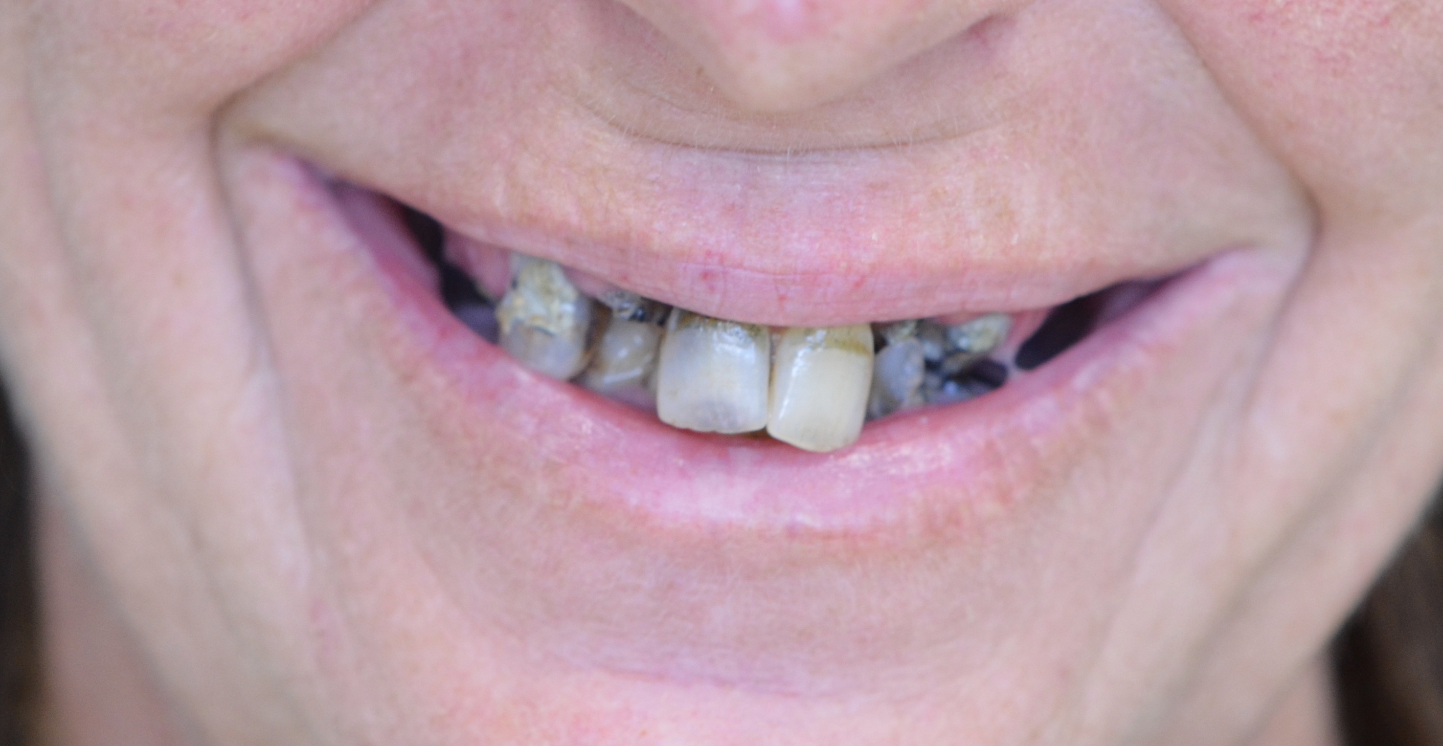 All On 4 Before | Taylor Dental Implants and Aesthetics All On 4 Before
