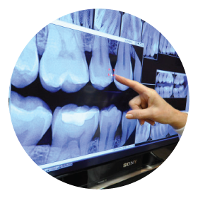 all-on-4-procedure-step-2-xray